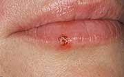 Herpes